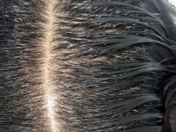 Scalp after hair restoration treatment by Dr. Tariq Alharbi