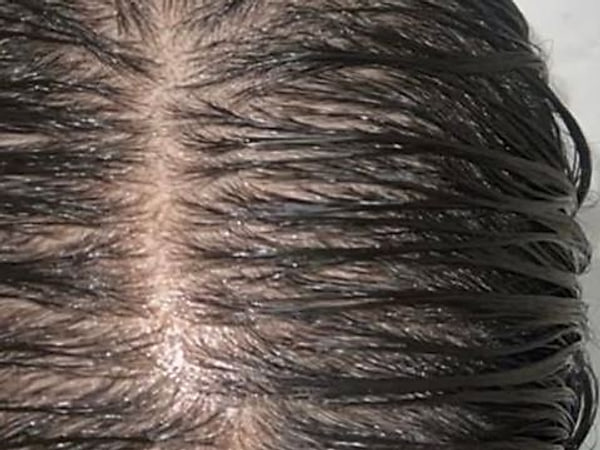 Scalp before hair restoration treatment