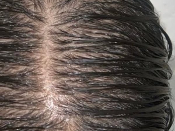 Scalp before hair restoration treatment