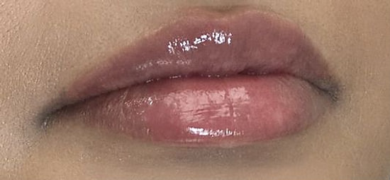 Lips after filler treatment by Dr. Sara Aldokhayel