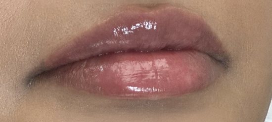 Lips after filler treatment by Dr. Sara Aldokhayel