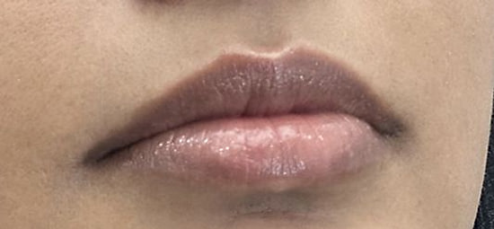 Lips before filler treatment