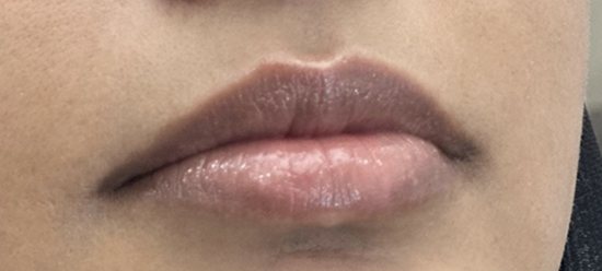 Lips before filler treatment